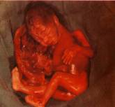 Виды абортов: солевой асминоцентез