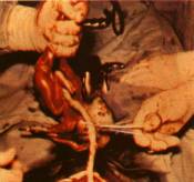 Виды абортов: гистеротомия