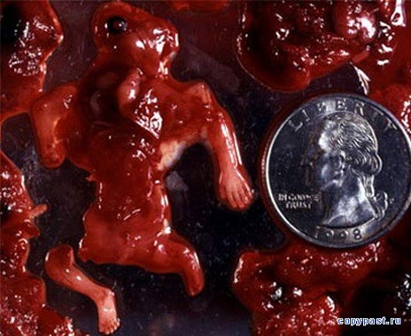 Аборт фото. Abortion photo